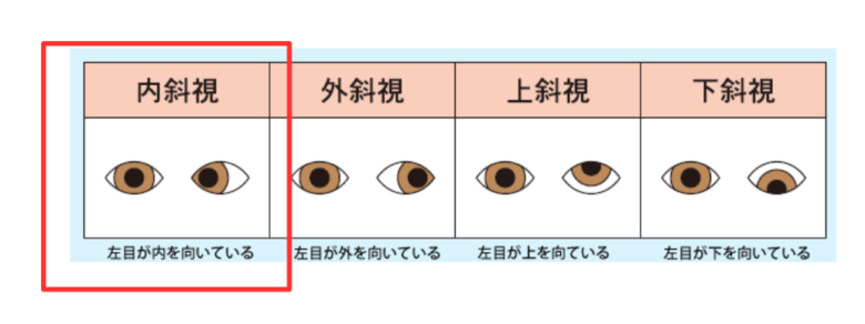 マナトの斜視